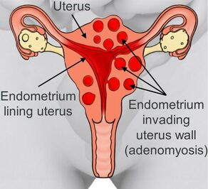 Diagram showing a uterus affected by adenomyosis