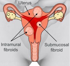 Learn Why Fibroids Cause Heavy Bleeding During & Between Periods!