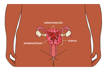 Diagram of a uterus affected by adenomyosis