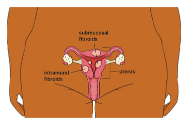 Diagram of a uterus with different types of fibroids.