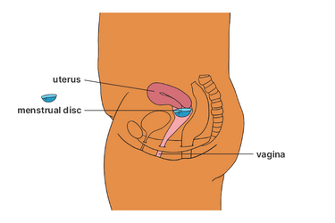 Diagram showing where a menstrual disc is placed